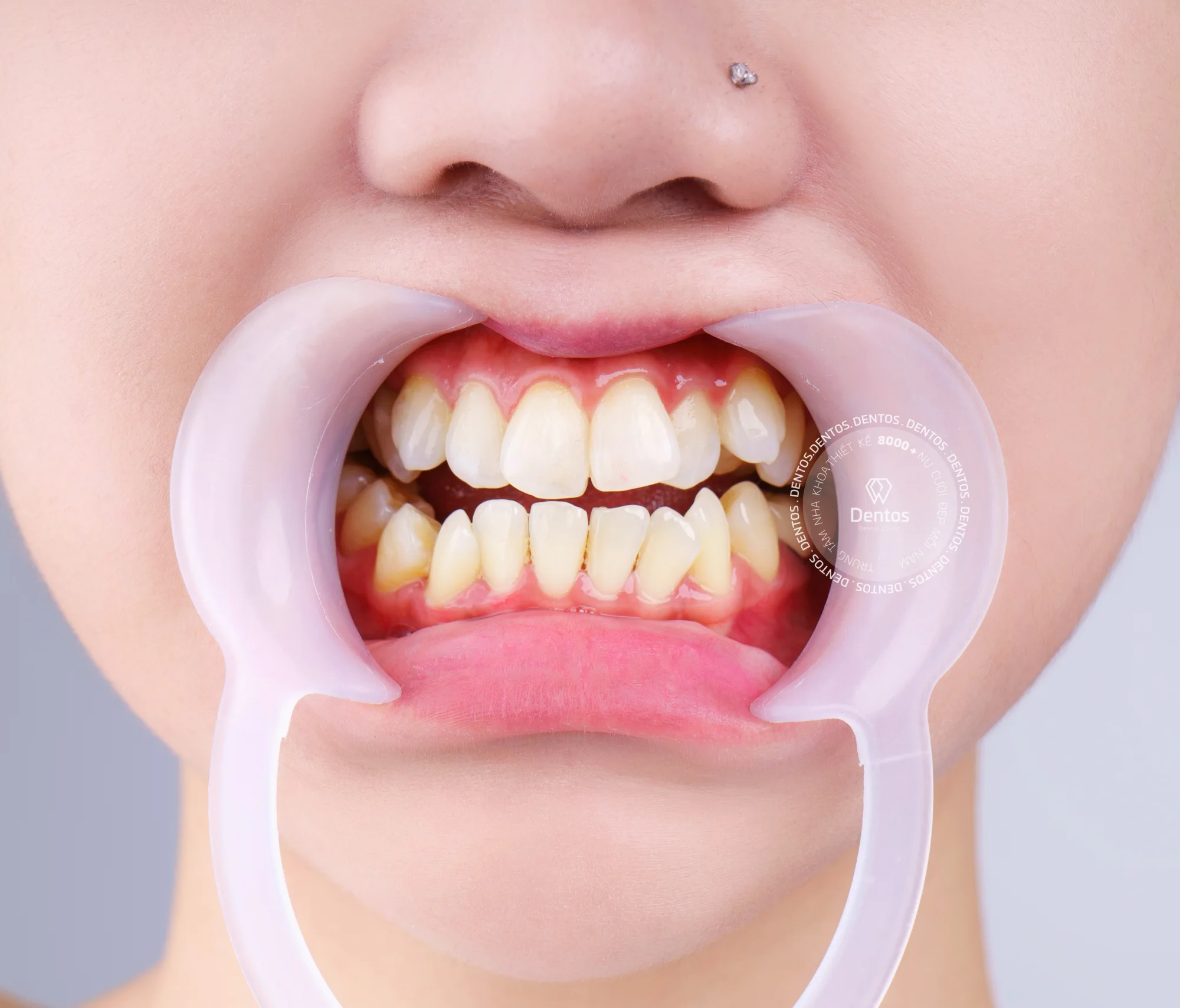 Răng lệch lạc khiến nụ cười kém duyên, làm mất tự tin trong giao tiếp